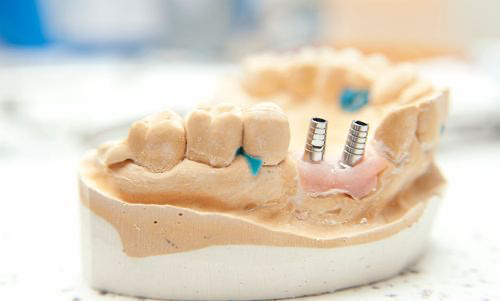 Implant in Bone Deficiency