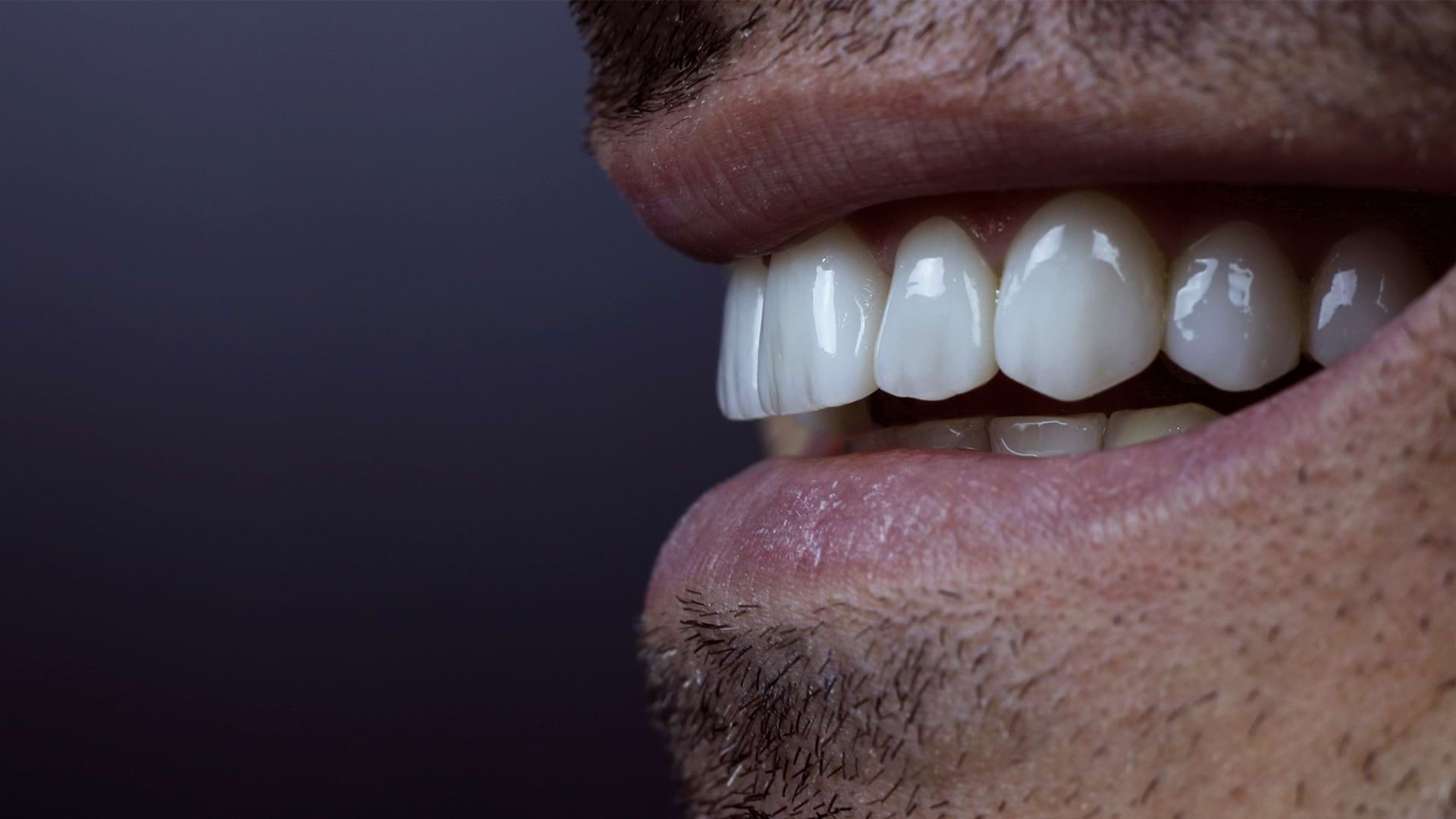 Porcelain Laminate Veneers